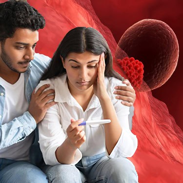 IUI –Intrauterine Insemination or Artificial Insemination (AI)